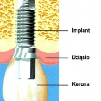 MEDYK DENT. Producent. Implanty stomatologiczne.