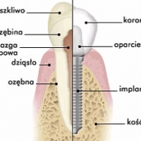 IMPLANTY ZĘBÓW. Producent. Implanty stomatologiczne.