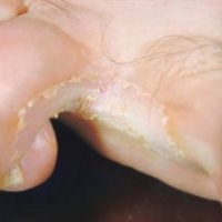 Sól do stóp ze skłonnościami do grzybicy i pękania między palcami. A012.