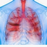 1000: ब्राँकायटिस हा बहुधा व्हायरल, श्वसन रोगाचा एक सामान्य रोग आहे.