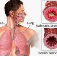 Bronhīts visbiežāk ir vīrusu, ļoti izplatīta elpceļu slimība.