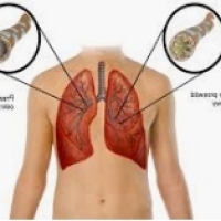 La bronquitis es con mayor frecuencia una enfermedad respiratoria viral muy común.