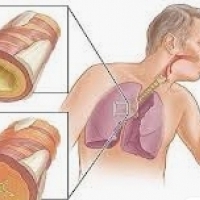La bronchite est le plus souvent une maladie respiratoire virale très courante.