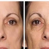 Lëkura kapilar: kujdesi për fytyrën dhe kozmetikë për lëkurën kapilar.