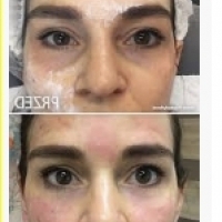 Капиларна кожа: нега на лице и козметика за капиларна кожа.