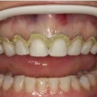 How to prevent gum recession and the accompanying bothersome symptoms?