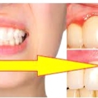 How to prevent gum recession and the accompanying bothersome symptoms?