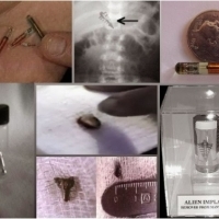 ALIEN IMPLANTS - HAVE EVERYONE ON EARTH HAS BEEN CAPTURED BY A UFO?