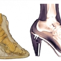 Po lewej - przekrój przez stopę słonia; po prawej - przekrój przez stopę człowieka.