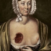 Jest to jeden z sześciu portretów przedstawiających kobietę po usunięciu guza piersi.