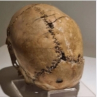 Na pierwszym zdjęciu widać animację procesu trepanacji, a na drugim kobiecą czaszkę w Aşıklı Höyük, Turcja.