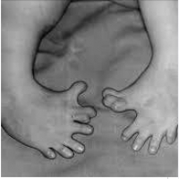 Najbardziej bolesny przykład pokazujący, jak leki stosowane w ciąży mogą spowodować wady wrodzone.  „Klęska talidomidu”.