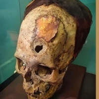 Medycyna w starożytnym Peru - Zaskakująca czaszka Paracas z implantem ze złotej folii.