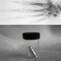 Implanty te często znajdują się w różnych lokalizacjach.