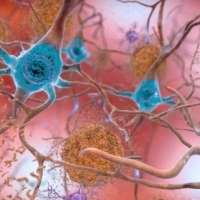 Alzheimer: Tajemnica choroby rozwiązana.