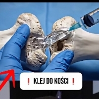 Klej do złamanych kości. 
